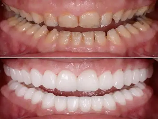 Full-Mouth Rehabilitation