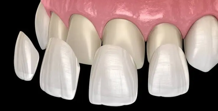 Dental Veneers